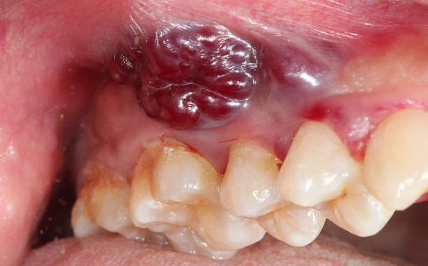 oral-cancer-4